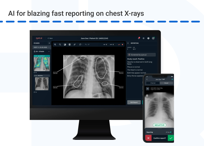 AI for Blazing Fast Reporting on Chest X Rays - How AI Is Improving Medical Diagnostics and Disease Detection